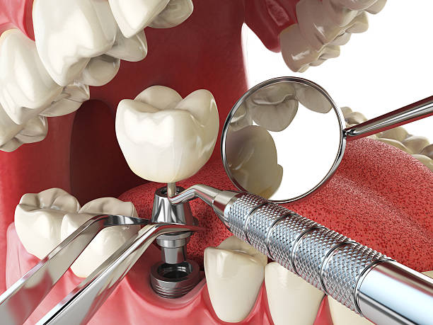 Best Emergency Treatment for Toothache in La Nte, MO